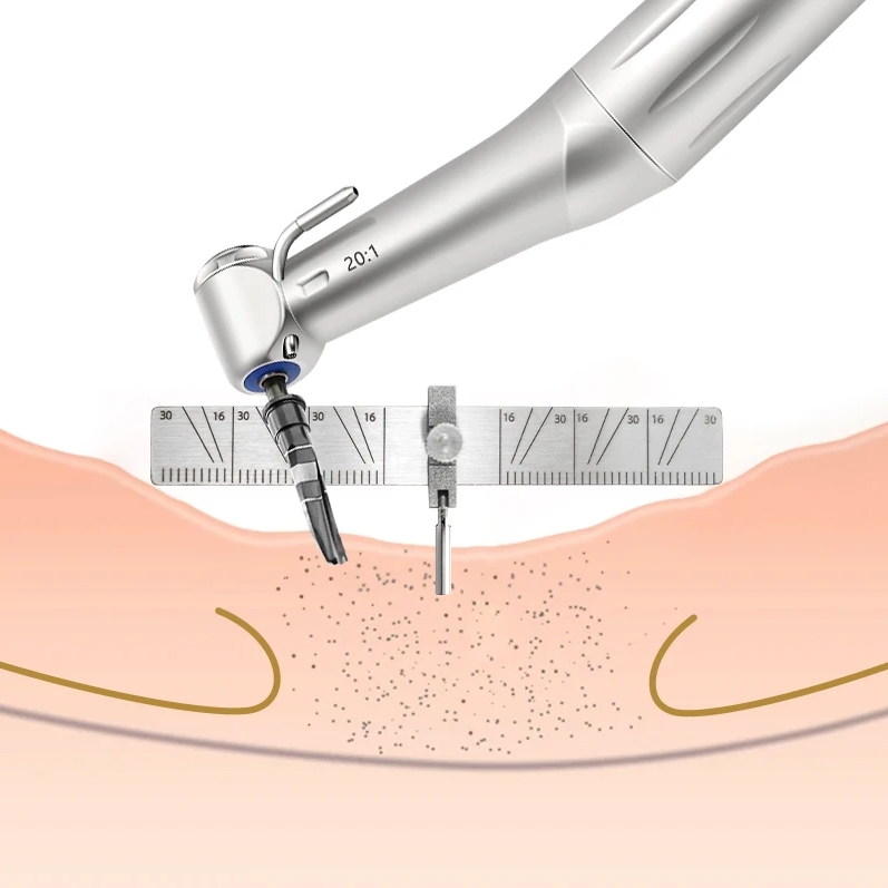 Positioning Implant Instruments Dental Implant Positioning Locator Angle Ruler Guage – agdentool